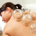 Acupuncture cupping on woman's back